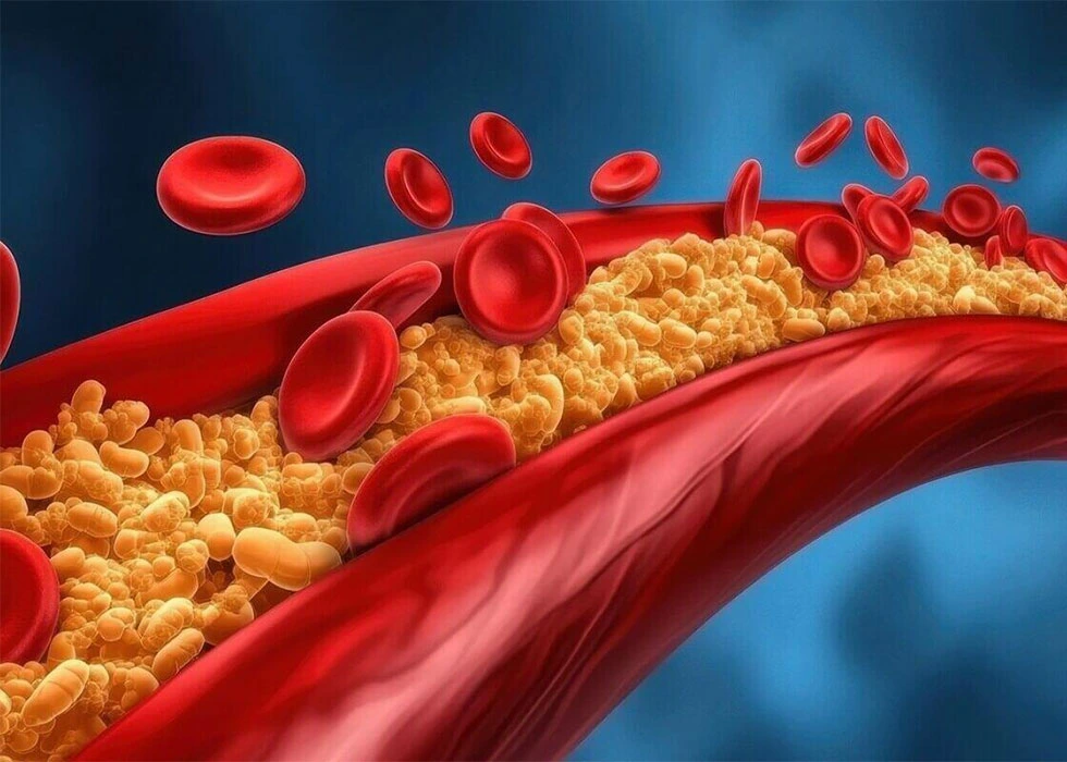 بەرزبوونی چەوریی خوێن Hyperlipidemia (high cholesterol)