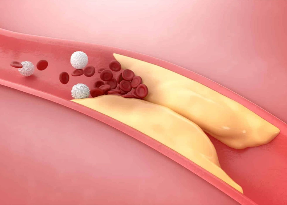 بەرزبوونی چەوریی خوێن