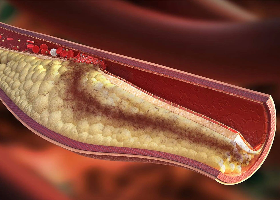 بەرزبوونی چەوریی خوێن
