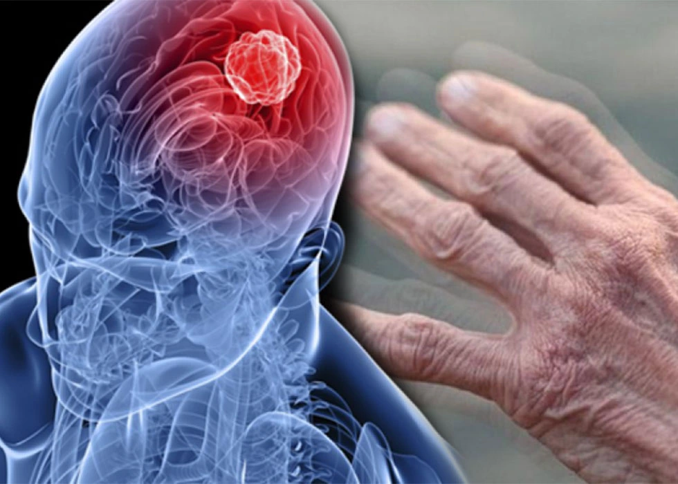 نەخۆشیی پارکینسۆن