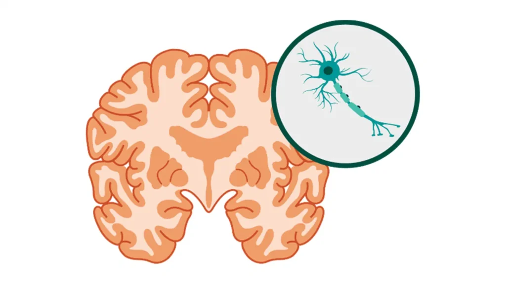 نەخۆشی ئەلزهایمێر