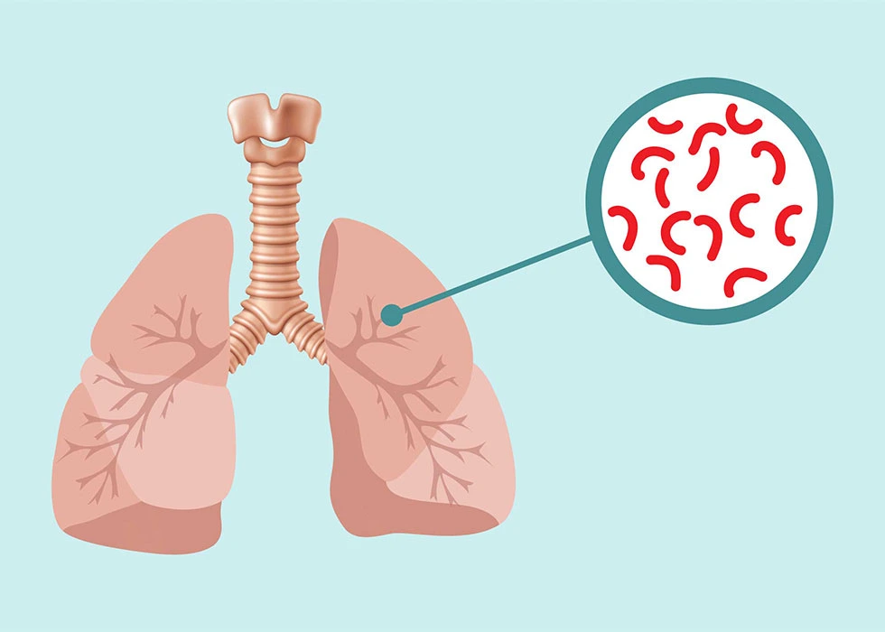 نەخۆشیی ڕەبۆ