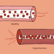 بەرزیی پەستانی خوێن