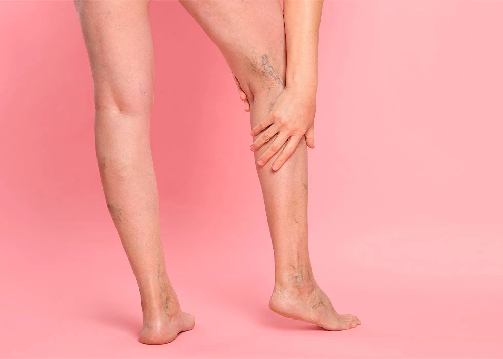 ئاوسانی خوێنھێنەرەکان | دەوالی | varicose veins