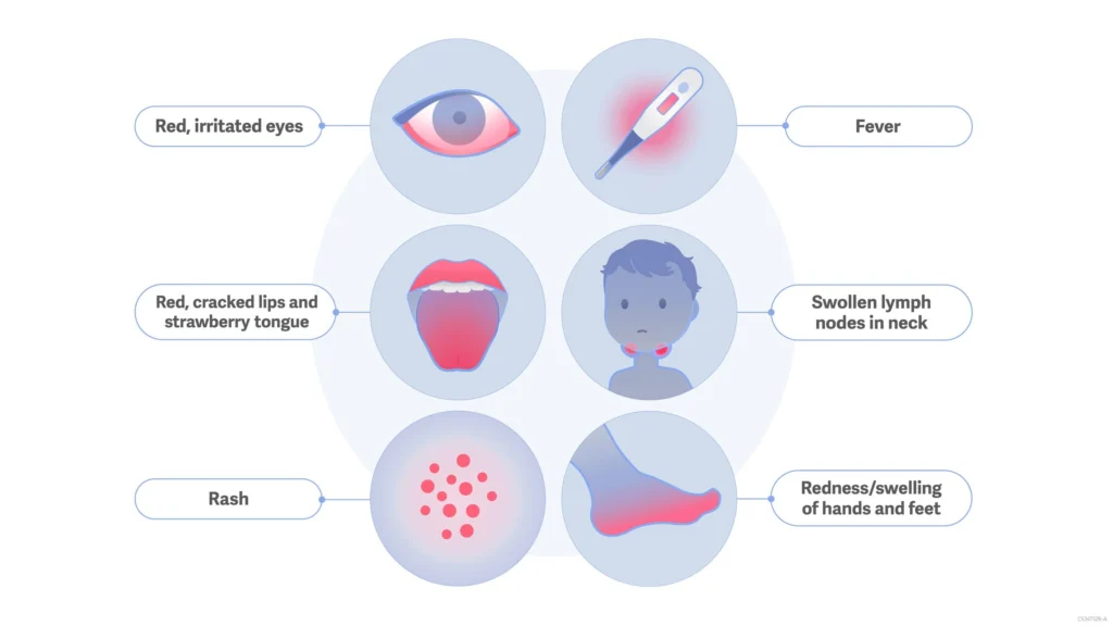 نەخۆشیی کاواساکی
